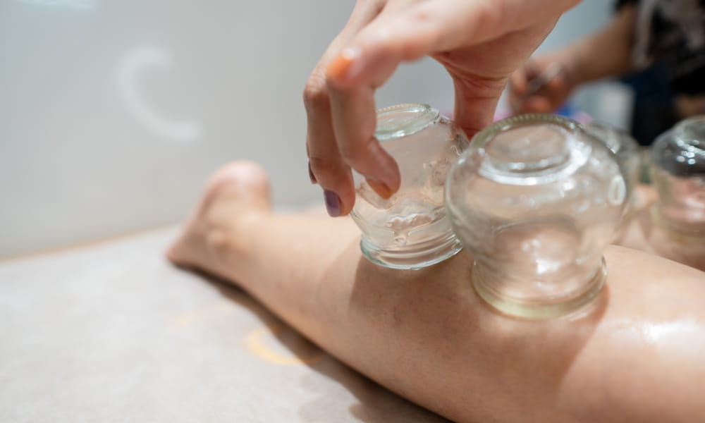 カッピング治療