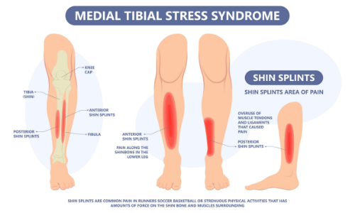 シンスプリントのイラスト