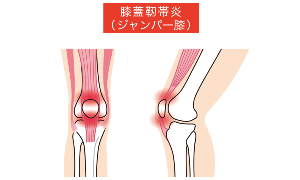 ジャンパー膝