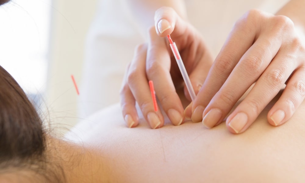 鍼灸の鍼治療