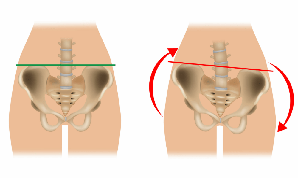 骨盤の歪み正面